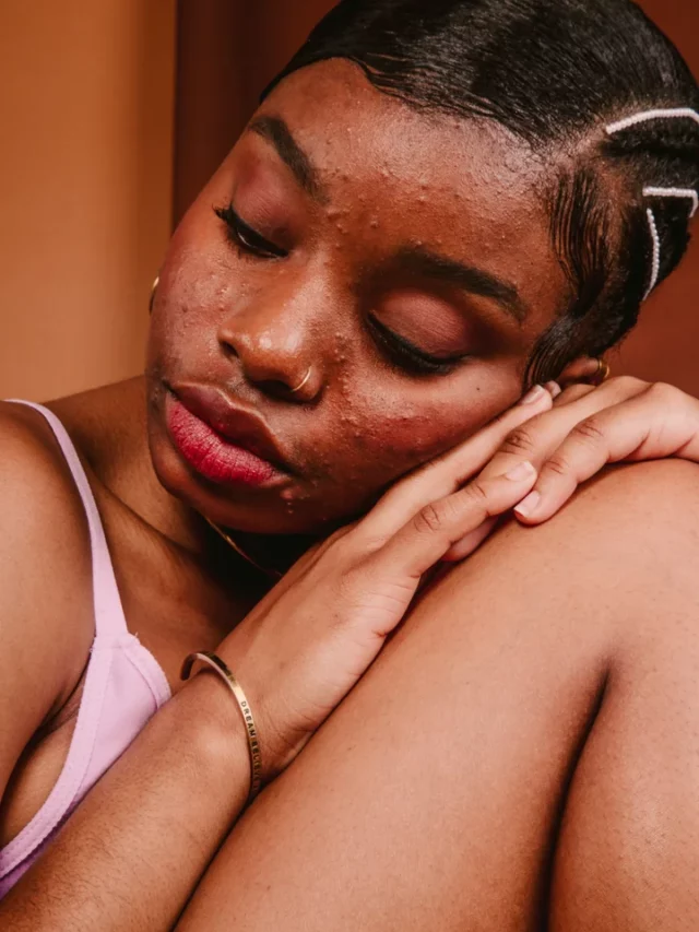 Acne Myths vs. Facts: Busting Common Misconceptions
